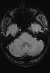 File:Cerebral hemorrhagic contusions. temporal evolution (Radiopaedia 40224-42757 Axial 81).png