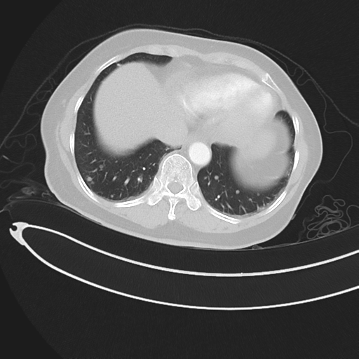 Cerebral metastases (Radiopaedia 33041-34055 Axial lung window 43).png