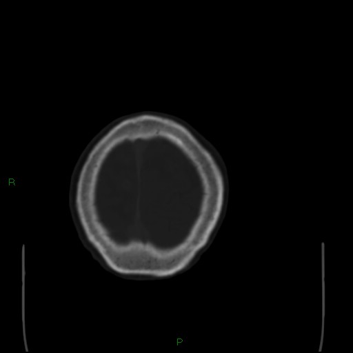 Cerebral metastases - breast primary (Radiopaedia 77653-89857 Axial bone window 106).jpg