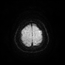 Cerebral metastases - melanoma (Radiopaedia 80972-94522 Axial DWI 27).jpg
