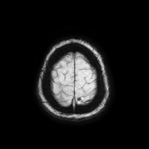 Cerebral metastases - melanoma (Radiopaedia 80972-94522 Axial SWI 90).jpg