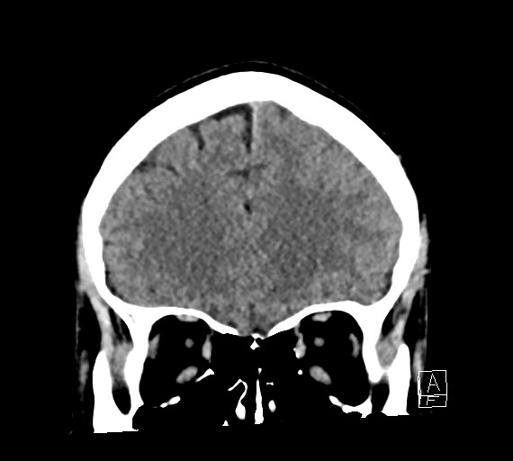 Cerebral metastases - testicular choriocarcinoma (Radiopaedia 84486-99855 Coronal C+ delayed 17).jpg