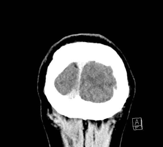 Cerebral metastases - testicular choriocarcinoma (Radiopaedia 84486-99855 D 59).jpg