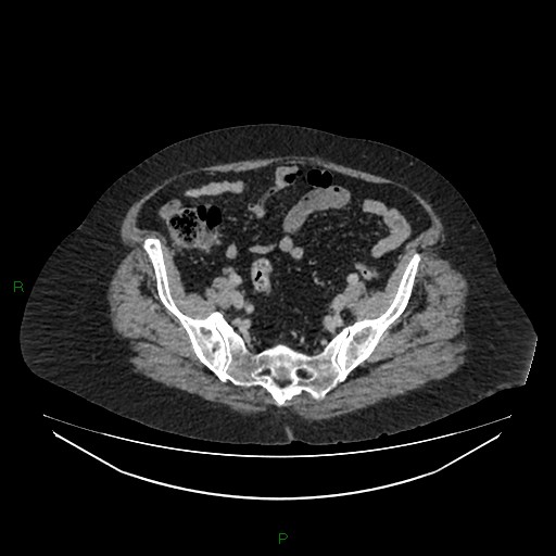 Cerebral metastasis from renal cell carcinoma (Radiopaedia 82306-96378 A 147).jpg