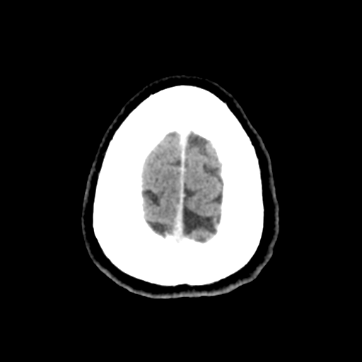 Cerebral metastasis to basal ganglia (Radiopaedia 81568-95412 Axial C+ delayed 52).png