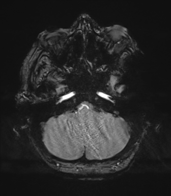 Cerebral metastasis to basal ganglia (Radiopaedia 81568-95413 Axial SWI magnitude 14).png