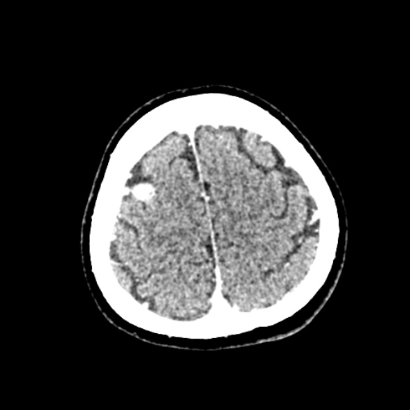 Cerebral ring enhancing lesions - cerebral metastases (Radiopaedia 44922-48818 B 241).jpg