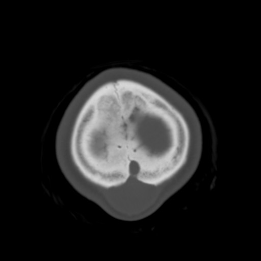 Cerebral tuberculosis with dural sinus invasion (Radiopaedia 60353-68018 Axial bone window 62).jpg