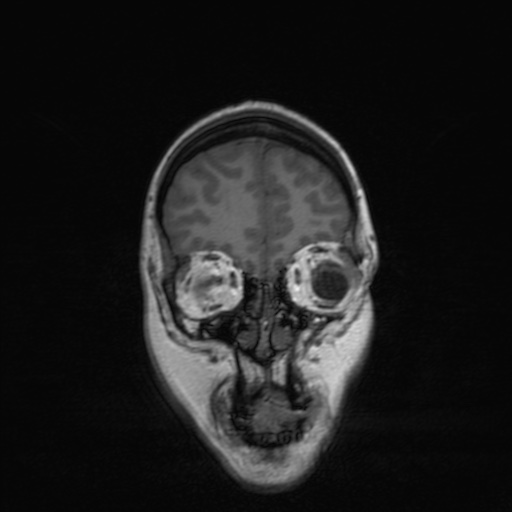 Cerebral tuberculosis with dural sinus invasion (Radiopaedia 60353-68090 Coronal T1 39).jpg