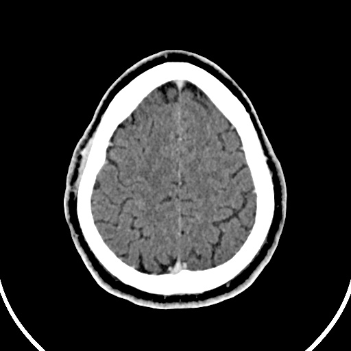 Cerebral venous angioma (Radiopaedia 69959-79977 B 87).jpg