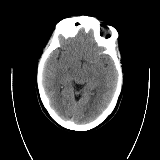 File:Cerebral venous infarct related to dural venous sinus thromboses (Radiopaedia 35292-36804 Coronal non-contrast 1).png