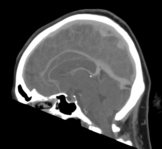File:Cerebral venous infarction due to transverse sinus thrombosis (Radiopaedia 34688-36120 Sagittal CT venogram 28).png