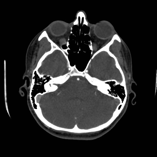 Cerebral venous sinus thrombosis (Radiopaedia 40619-43227 A 59).jpg