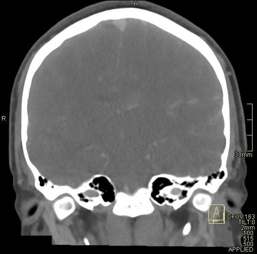 File:Cerebral venous sinus thrombosis (Radiopaedia 91329-108965 Coronal venogram 48).jpg