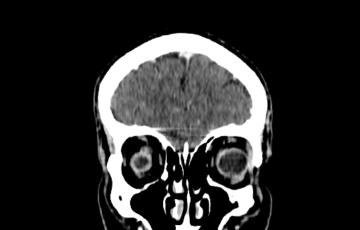File:Cerebral venous thrombosis (CVT) (Radiopaedia 77524-89685 C 8).jpg