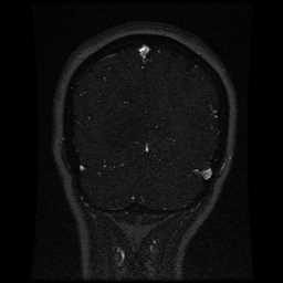 Cerebral venous thrombosis - ulcerative colitis (Radiopaedia 66049-75219 Coronal MRV 27).jpg