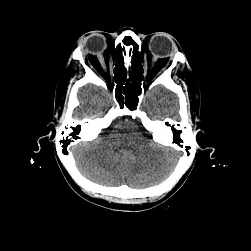 Cerebral venous thrombosis with venous hemorrhagic infarct (Radiopaedia 90354-107660 Axial non-contrast 14).jpg
