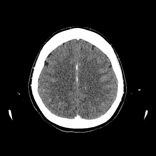 Cerebral venous thrombosis with venous hemorrhagic infarct (Radiopaedia 90354-107660 Axial with contrast 119).jpg
