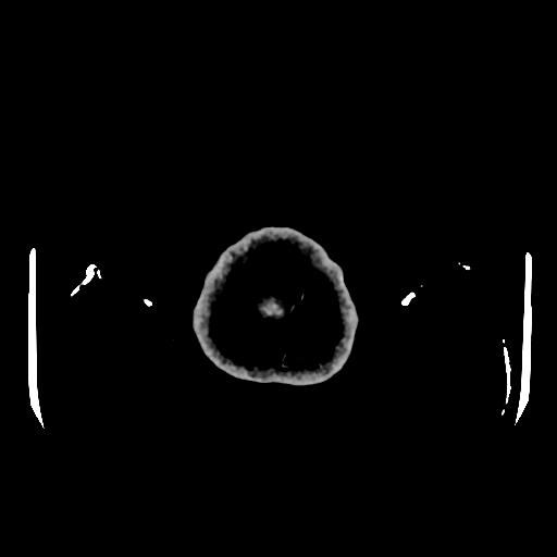 Cerebral venous thrombosis with venous hemorrhagic infarct (Radiopaedia 90354-107660 Axial with contrast 176).jpg