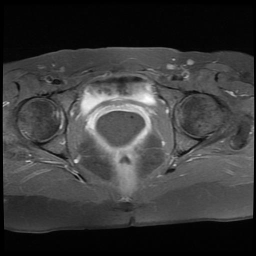 File:Cervical cancer (Radiopaedia 62991-71413 Axial T1 C+ fat sat 14).jpg