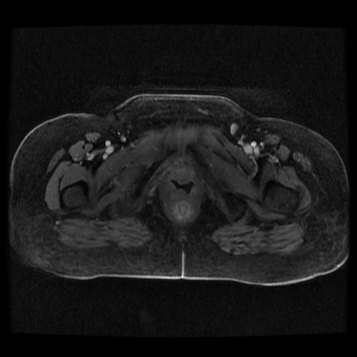Cervical carcinoma (Radiopaedia 70924-81132 Axial T1 C+ fat sat 24).jpg
