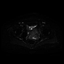 Cervical carcinoma (Radiopaedia 85405-101028 Axial DWI 8).jpg
