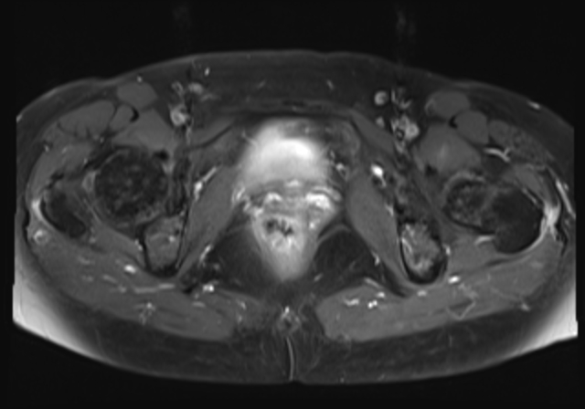 File:Cervical carcinoma (Radiopaedia 88312-104943 Axial T1 C+ fat sat 17).jpg
