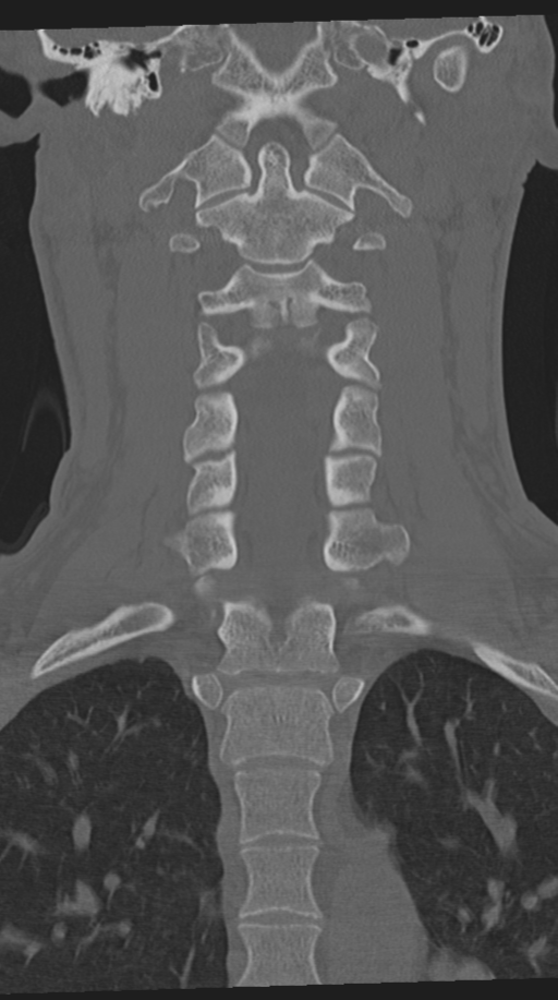 Cervical intercalary bone (Radiopaedia 35211-36748 Coronal bone window 39).png