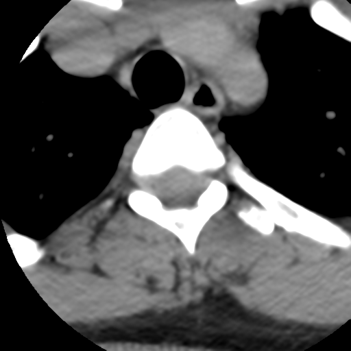Cervical schwannoma (Radiopaedia 57979-64974 Axial non-contrast 70).png