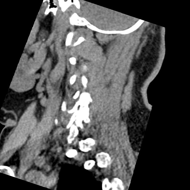 Cervical spinal neurofibroma in a patient with NF1 (Radiopaedia 58344-65464 C 41).jpg