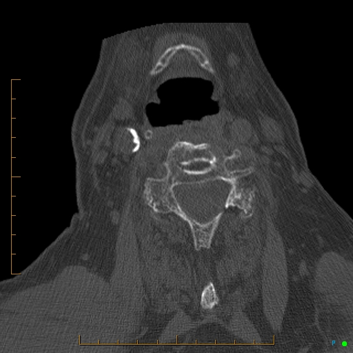 Cervical spine fracture - ankylosing spondylitis (Radiopaedia 76835-88706 Axial bone window 127).jpg