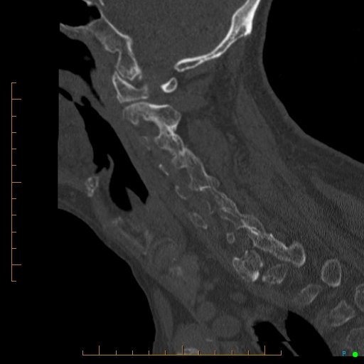 Cervical spine fracture - ankylosing spondylitis (Radiopaedia 76835-88706 Sagittal bone window 74).jpg