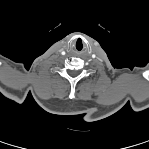 File:Cervical spine fractures with vertebral artery dissection (Radiopaedia 53296-59269 A 36).png