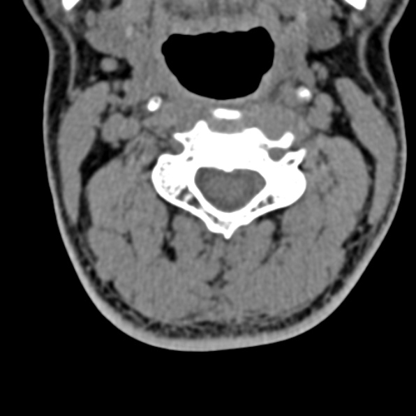 Cervical spondylodiscitis (Radiopaedia 28057-29489 Axial non-contrast 32).jpg