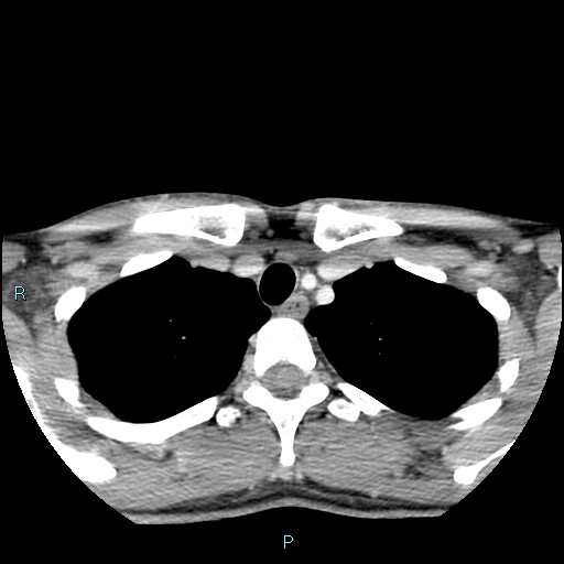 Cervical thymic cyst (Radiopaedia 88632-105335 C 20).jpg
