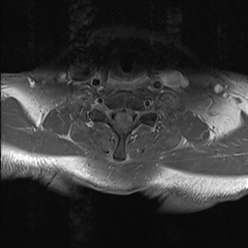File:Cervical tumor-like myelopathy due to Type V dAVF (Radiopaedia 82461-96604 Axial T1 C+ fat sat 25).jpg