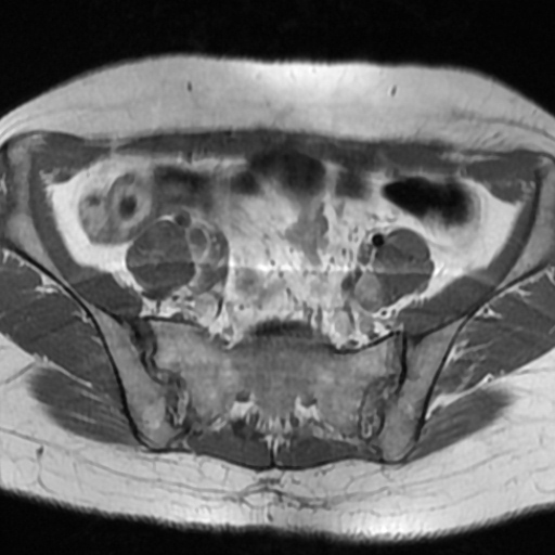 File:Cesarian section scar endometriosis (Radiopaedia 66520-75799 Axial T1 2).jpg