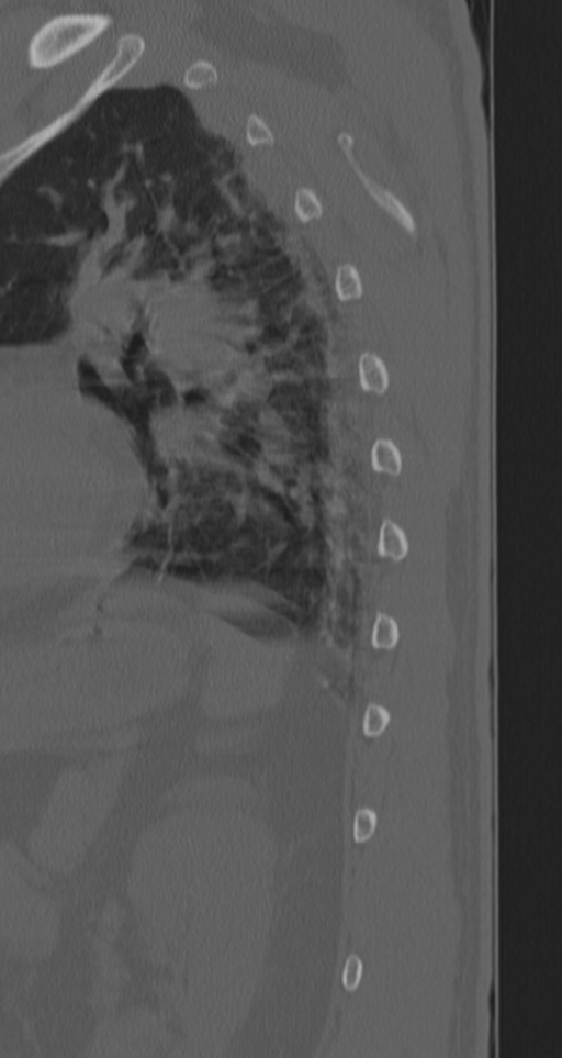Chance fracture (Radiopaedia 33854-35020 Sagittal bone window 11).png