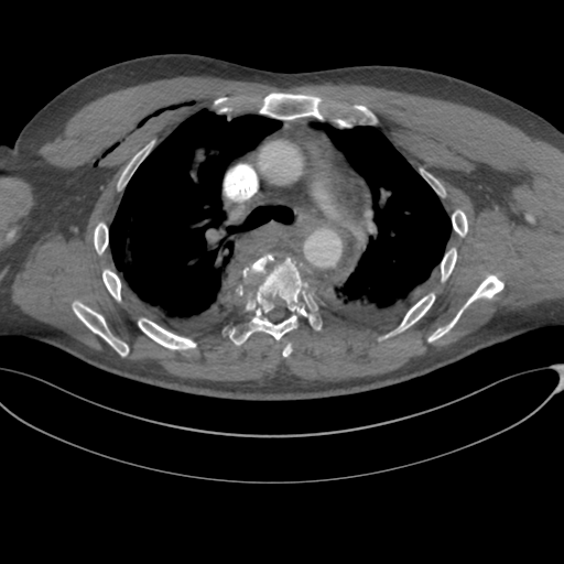File:Chest multitrauma - aortic injury (Radiopaedia 34708-36147 A 112).png