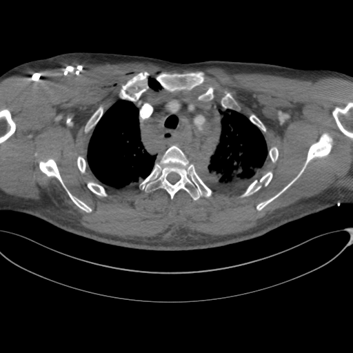 File:Chest multitrauma - aortic injury (Radiopaedia 34708-36147 A 65).png