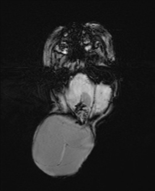 Chiari III malformation with occipital encephalocele (Radiopaedia 79446-92559 Axial SWI 25).jpg