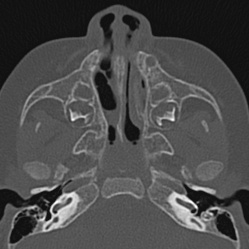 Choanal atresia (Radiopaedia 88525-105975 Axial bone window 26).jpg