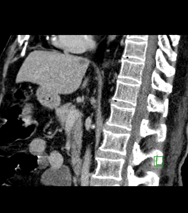 Cholangiocarcinoma with cerebral metastases (Radiopaedia 83519-98629 Sagittal C+ delayed 58).jpg