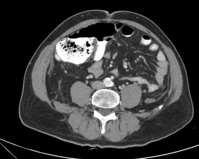Cholecystitis - perforated gallbladder (Radiopaedia 57038-63916 A 52).jpg