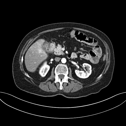 Cholecystoduodenal fistula due to calculous cholecystitis with gallstone migration (Radiopaedia 86875-103077 A 29).jpg
