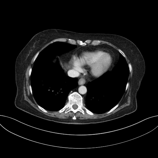 Cholecystoduodenal fistula due to calculous cholecystitis with gallstone migration (Radiopaedia 86875-103077 D 13).jpg