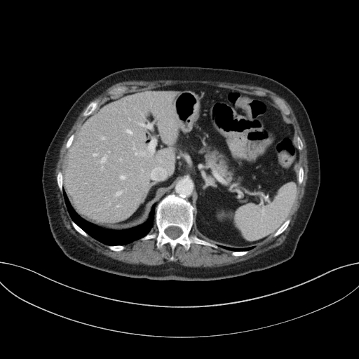 Cholecystoduodenal fistula due to calculous cholecystitis with gallstone migration (Radiopaedia 86875-103077 D 25).jpg