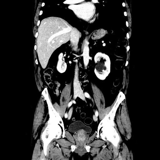 Choledocholiathiasis with normal caliber common bile duct (Radiopaedia 75368-86632 Coronal liver window 71).jpg