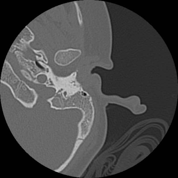Cholesteatoma (Radiopaedia 73023-83750 Axial Left ear 9).jpg