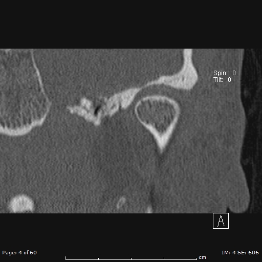 Cholesteatoma - external auditory canal (Radiopaedia 88452-105096 Coronal bone window 4).jpg